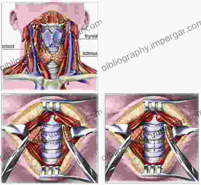 Tracheostomy Surgical Guide By Linda Domin Tracheostomy: A Surgical Guide Linda Domin